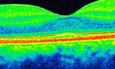 Optical Coherence Tomography or White Light Interferometry
